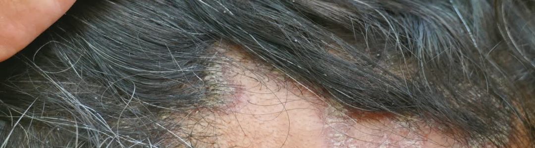 1200-675-21360169-thumbnail-16x9-scalp