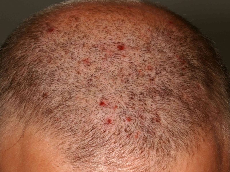 VWH-DermNetNZ-Folliculitis-01-3a01fb10ad3c4052a09dcf8943bf71ce